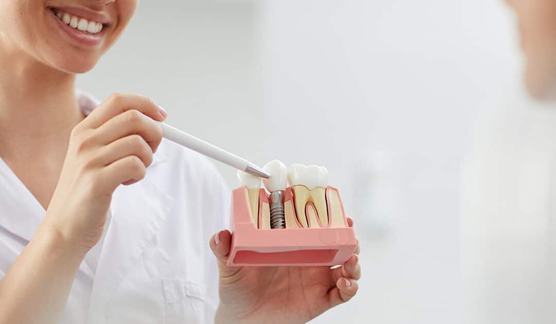 Types of Dental Implants: How Tooth Replacement is Improving