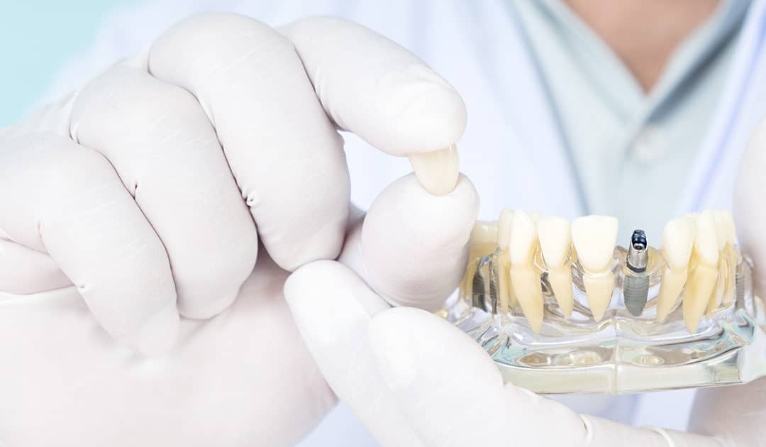 Is a Loose Dental Implant an Emergency?