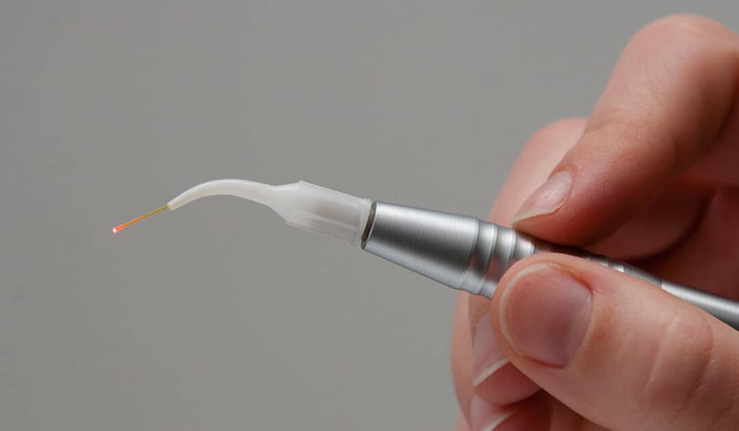 LANAP Benefits: Is Laser Gum Treatment Right for You?