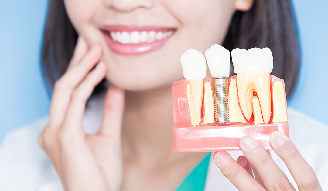 From Consultation to Final Crown: Understanding How Long a Dental Implant Procedures Takes