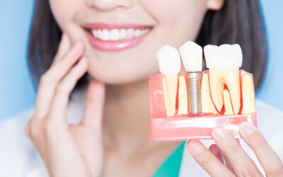 From Consultation to Final Crown: Understanding How Long a Dental Implant Procedures Takes