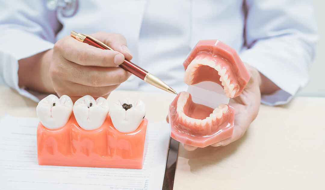 Early Cavity Treatment Options: Can You Get Drill-Free Cavity Treatment in Rochester, NY? 
