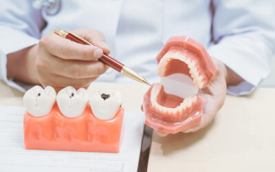 Early Cavity Treatment Options: Can You Get Drill-Free Cavity Treatment in Rochester, NY? 