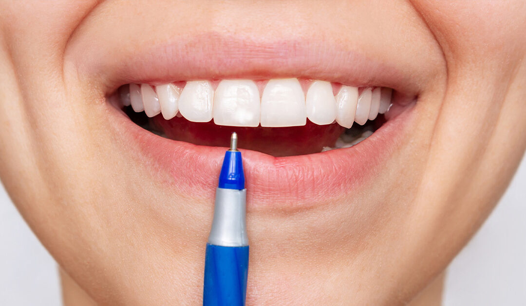 White Spot on a Tooth: Early Decay, Fluorosis, or Something Else?